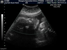 Vivian Sonograms